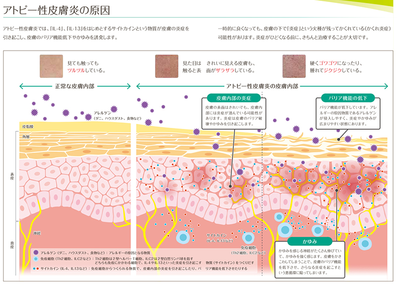 アトピー性皮膚炎の原因について図解