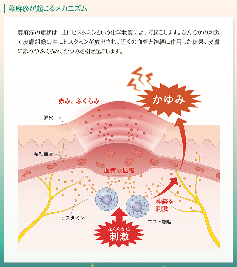 蕁麻疹が起こるメカニズム