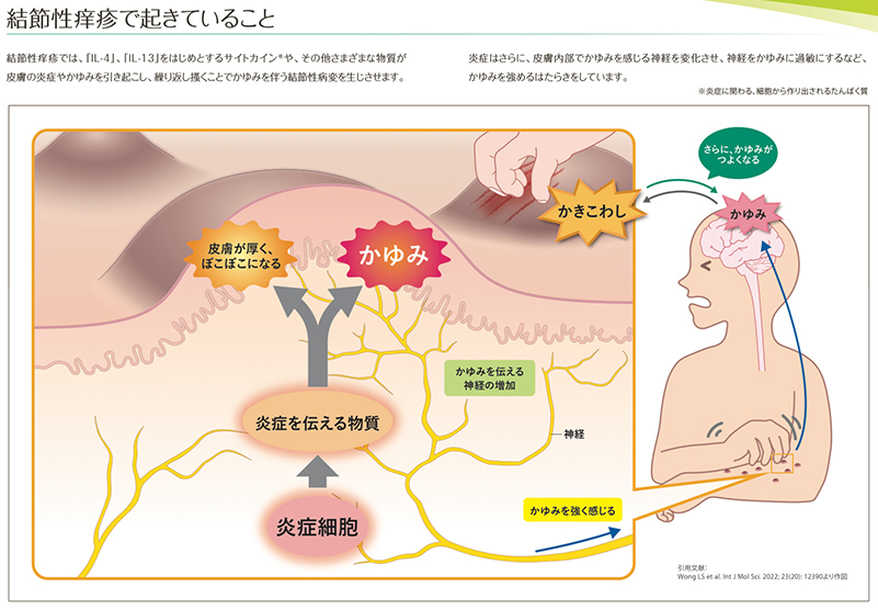 結節性痒疹で起きてること